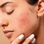 Tratamiento Rosácea